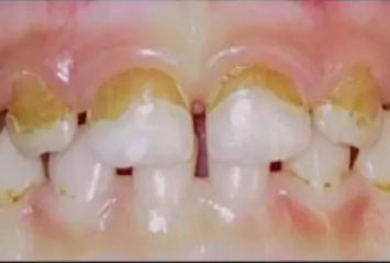 Face N Dental International Clinic in Nigdi Pimpri Chinchwad Pediatric Dentistry2