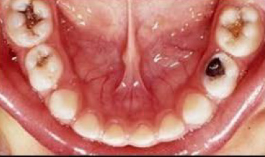 Face N Dental International Clinic in Nigdi Pimpri Chinchwad Pediatric Dentistry4