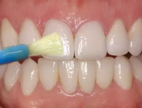 Face N Dental International Clinic in Nigdi Pimpri Chinchwad Fluoride Therapy1