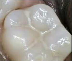 Face N Dental International Clinic in Nigdi Pimpri Chinchwad Fluoride Therapy4