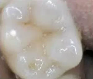 Face N Dental International Clinic in Nigdi Pimpri Chinchwad Fluoride Therapy3