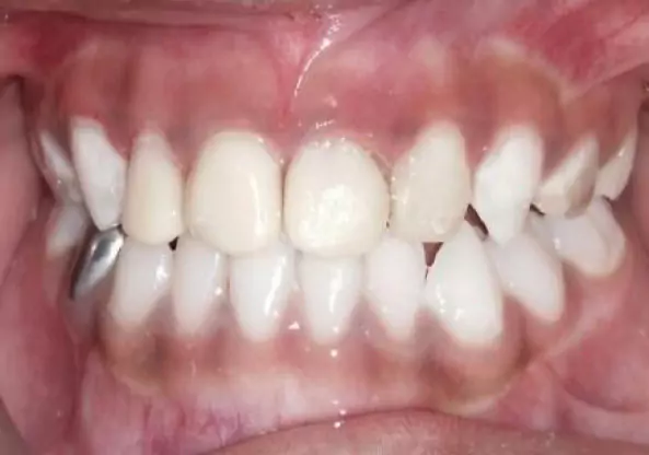 Face N Dental International Clinic in Nigdi Pimpri Chinchwad Filling Procedures