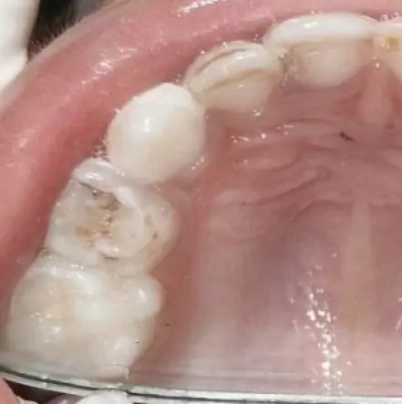 Face N Dental International Clinic in Nigdi Pimpri Chinchwad Filling Procedures Before
