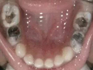 Face N Dental International Clinic in Nigdi Pimpri Chinchwad Capping Procedure image