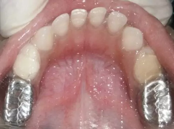 Face N Dental International Clinic in Nigdi Pimpri Chinchwad Capping Procedure image3