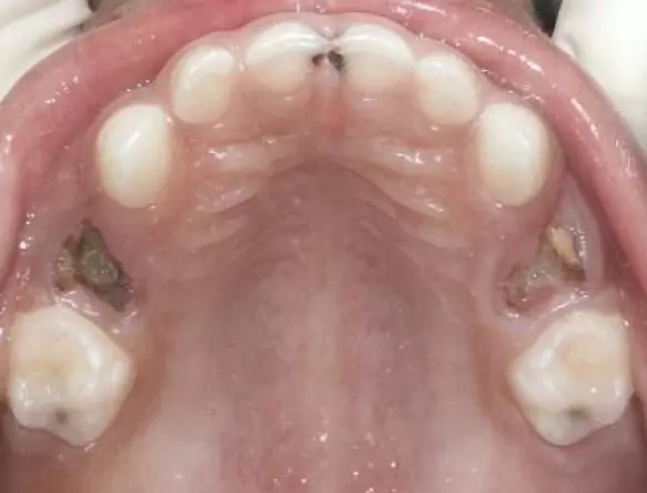 Face N Dental International Clinic in Nigdi Pimpri Chinchwad Capping Procedure image1