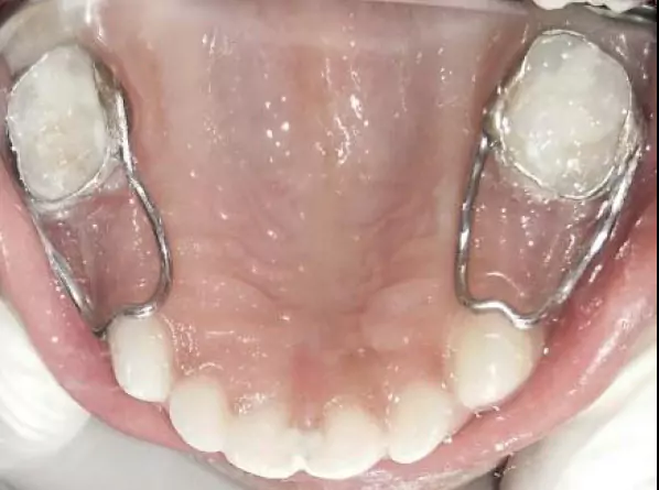Face N Dental International Clinic in Nigdi Pimpri Chinchwad Capping Procedure image4