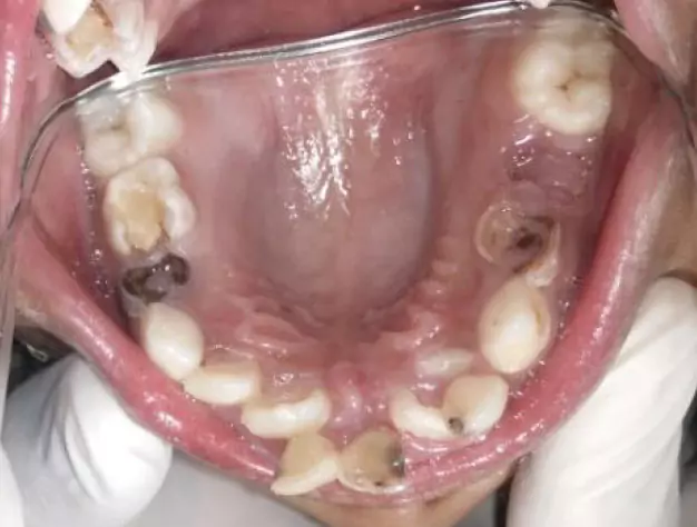 Face N Dental International Clinic in Nigdi Pimpri Chinchwad Capping Procedure image2