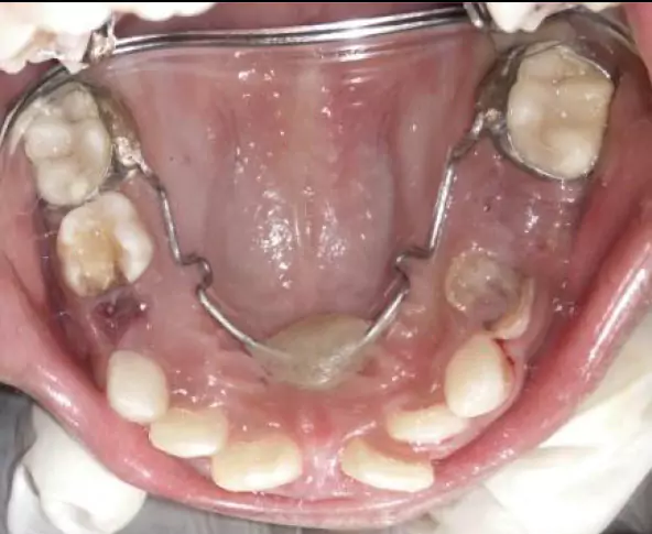 Face N Dental International Clinic in Nigdi Pimpri Chinchwad Capping Procedure image4