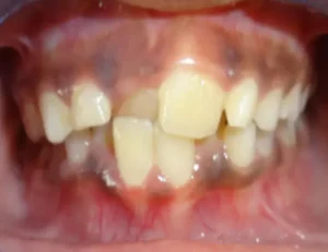 Face N Dental International Clinic in Nigdi Pimpri Chinchwad Malooclusions