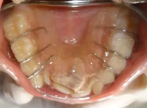 Face N Dental International Clinic in Nigdi Pimpri Chinchwad Malooclusions1
