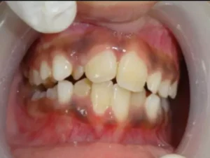 Face N Dental International Clinic in Nigdi Pimpri Chinchwad Malooclusions1