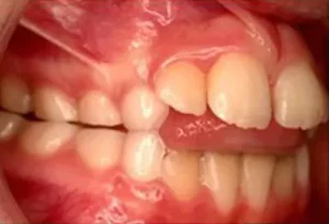 Face N Dental International Clinic in Nigdi Pimpri Chinchwad Tongue Thrusting