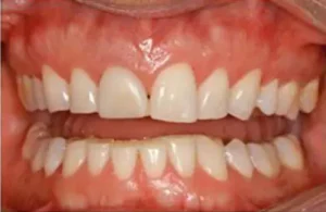 Face N Dental International Clinic in Nigdi Pimpri Chinchwad Bruxism