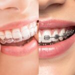 Braces