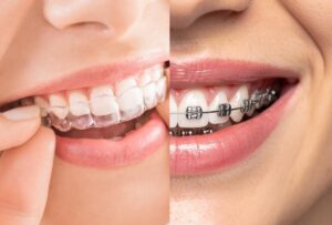 Braces