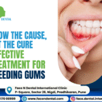 Face N Dental International Clinic Bleeding Gums Treatment in Pimpri Chinchwad