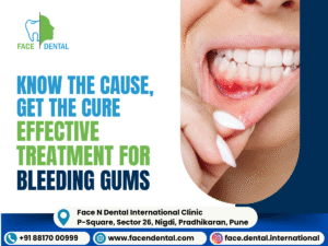 Face N Dental International Clinic Bleeding Gums Treatment in Pimpri Chinchwad