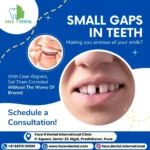 Face N Dental International Clinic teeth spacing treatment in Nigdi Primpri Chinchwad