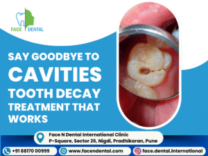 Face N Dental International Clinic tooth decay treatment in Pimpri Chinchwad