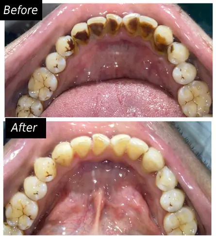 Gum Diseases Treatment face n dental international clinic in nigdi pimpri chinchwad image2