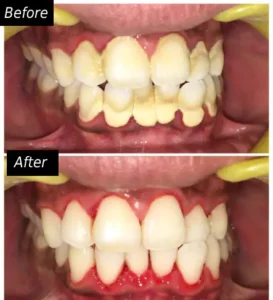 Gum Diseases Treatment face n dental international clinic in nigdi pimpri chinchwad image3