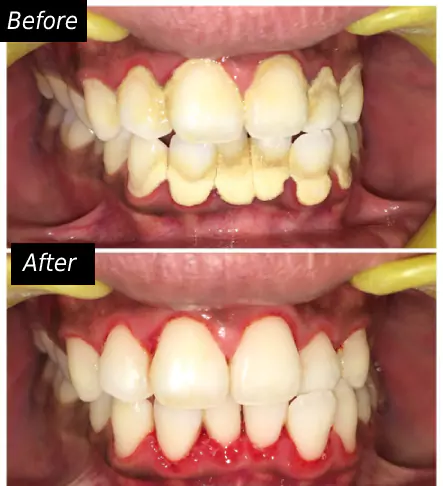 Gum Diseases Treatment face n dental international clinic in nigdi pimpri chinchwad image3