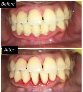 Gum Diseases Treatment face n dental international clinic in nigdi pimpri chinchwad image4
