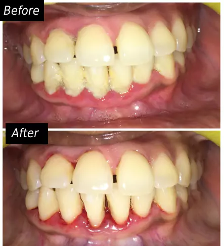 Gum Diseases Treatment face n dental international clinic in nigdi pimpri chinchwad image4