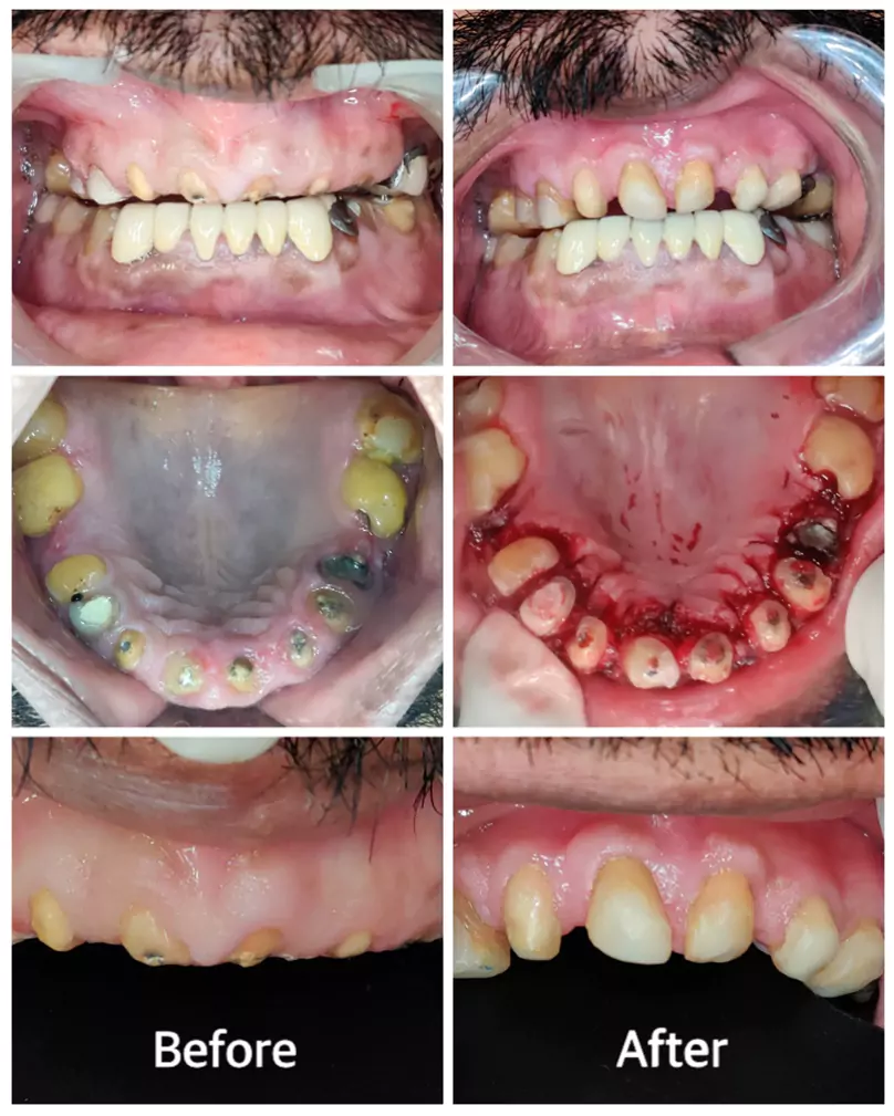 Gum Diseases Treatment face n dental international clinic in nigdi pimpri chinchwad image5