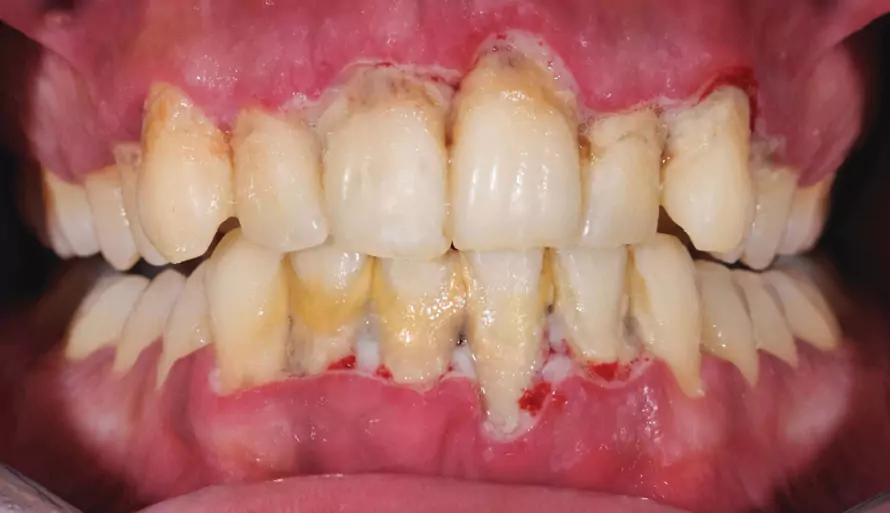 Gum Diseases Treatment face n dental international clinic in nigdi pimpri chinchwad