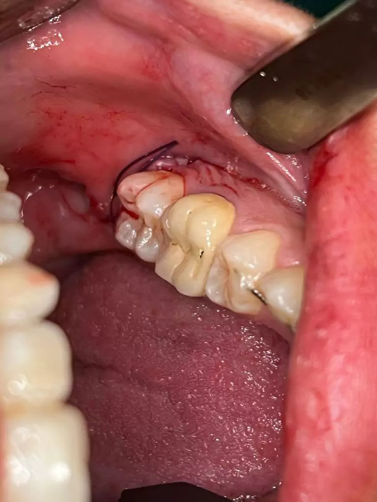 Face N Dental International Clinic Pain Free Wisdom Tooth Removal Surgery In Nigdi