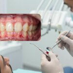 Signs of gum disease