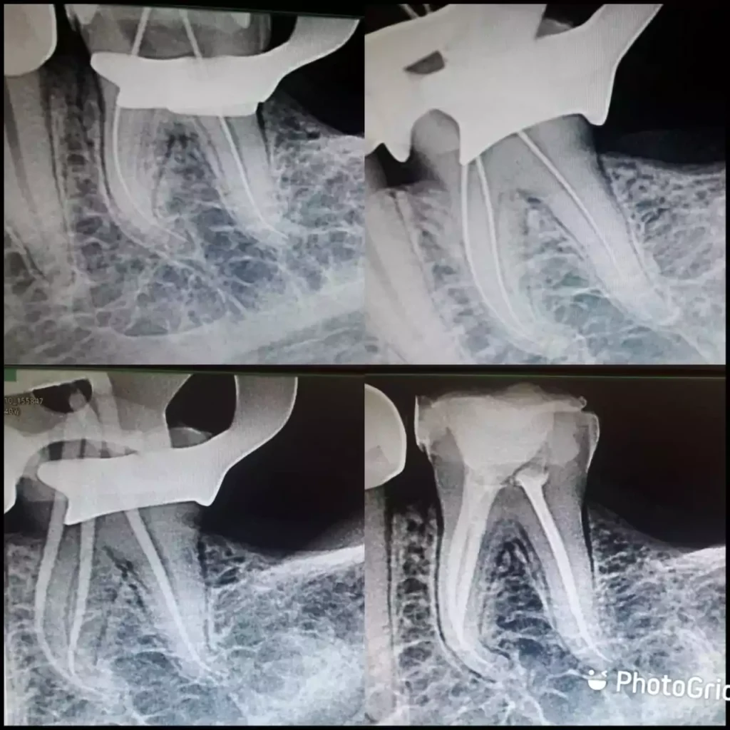 Face N Dental International Clinic Advance Root Canal Treatment in Nigdi Image11