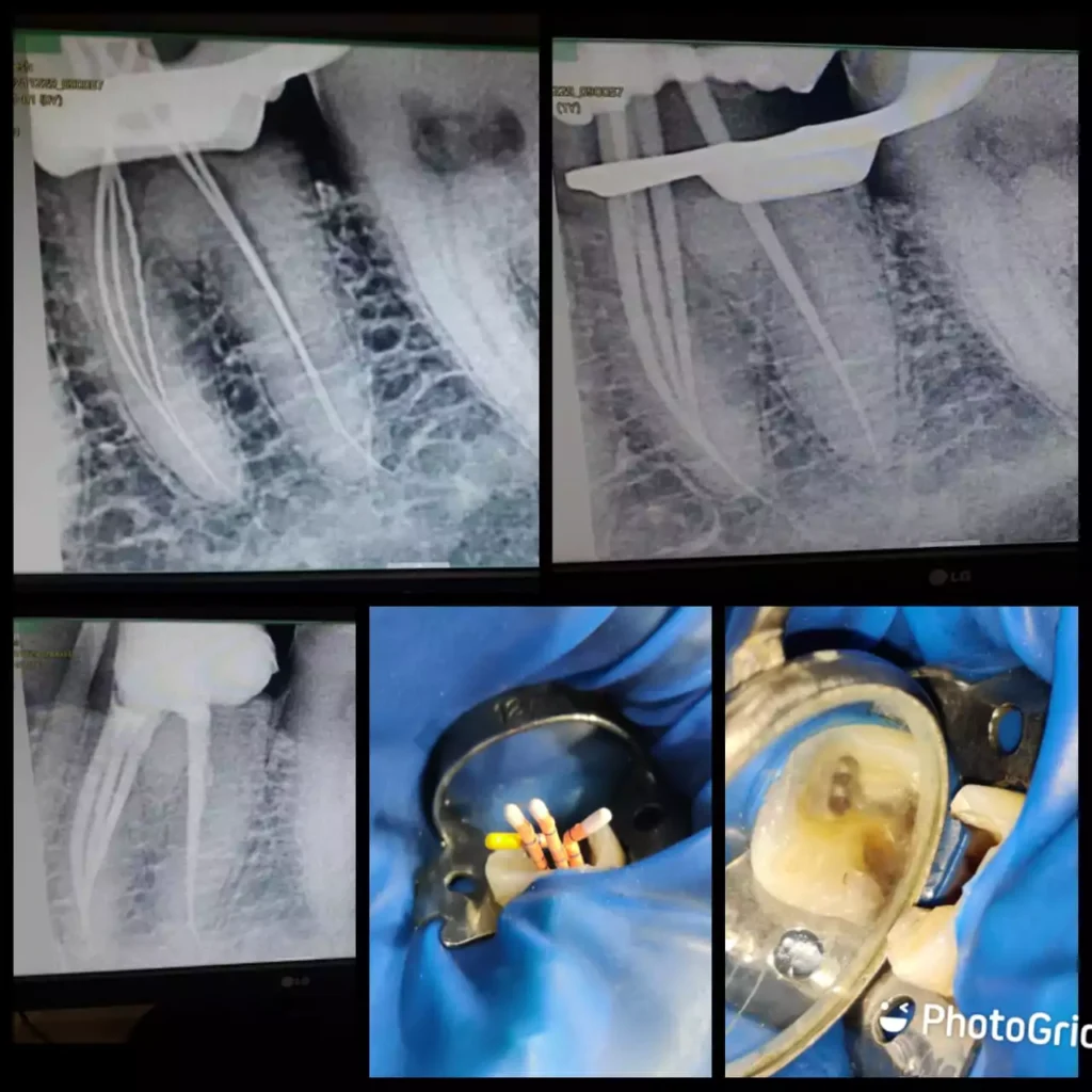 Face N Dental International Clinic Advance Root Canal Treatment in Nigdi Image3