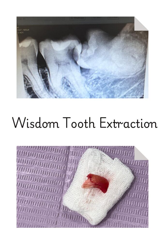 Face N Dental International Clinic Wisdom Tooth Extraction In Nigdi