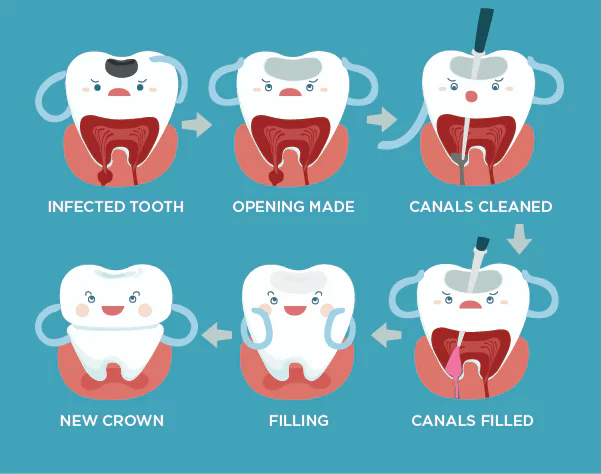 Face N Dental International Clinic in Nigdi Pimpri Chinchwad Capping Procedure