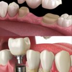 Dental Implant vs Dental Bridge
