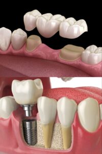 Dental Implant vs Dental Bridge