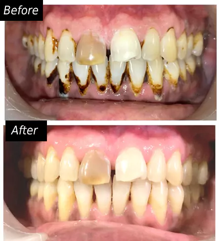 Gum Diseases Treatment face n dental international clinic in nigdi pimpri chinchwad image1