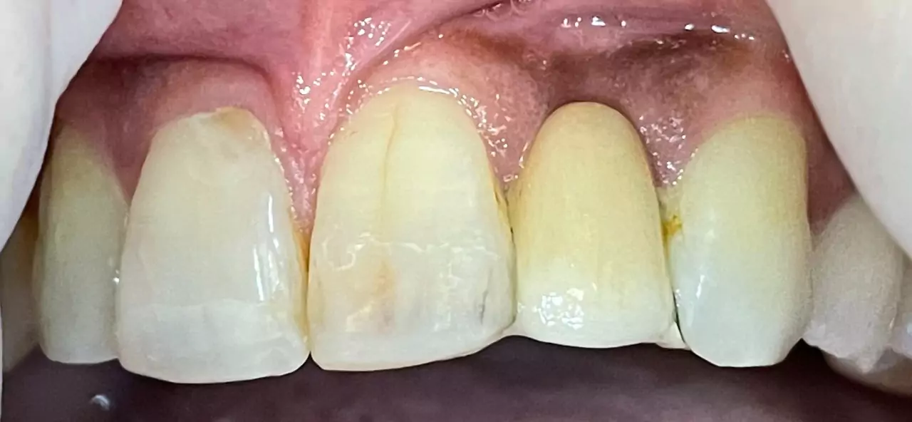Replacement of Missing Teeth in Nigdi Pimpri Chinchwad Pune Face N Dental International Clinic