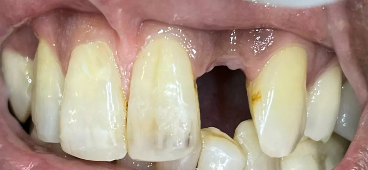 Replacement of Missing Teeth in Nigdi Pimpri Chinchwad Pune Replacement of Missing Teeth in Nigdi Pimpri Chinchwad Pune