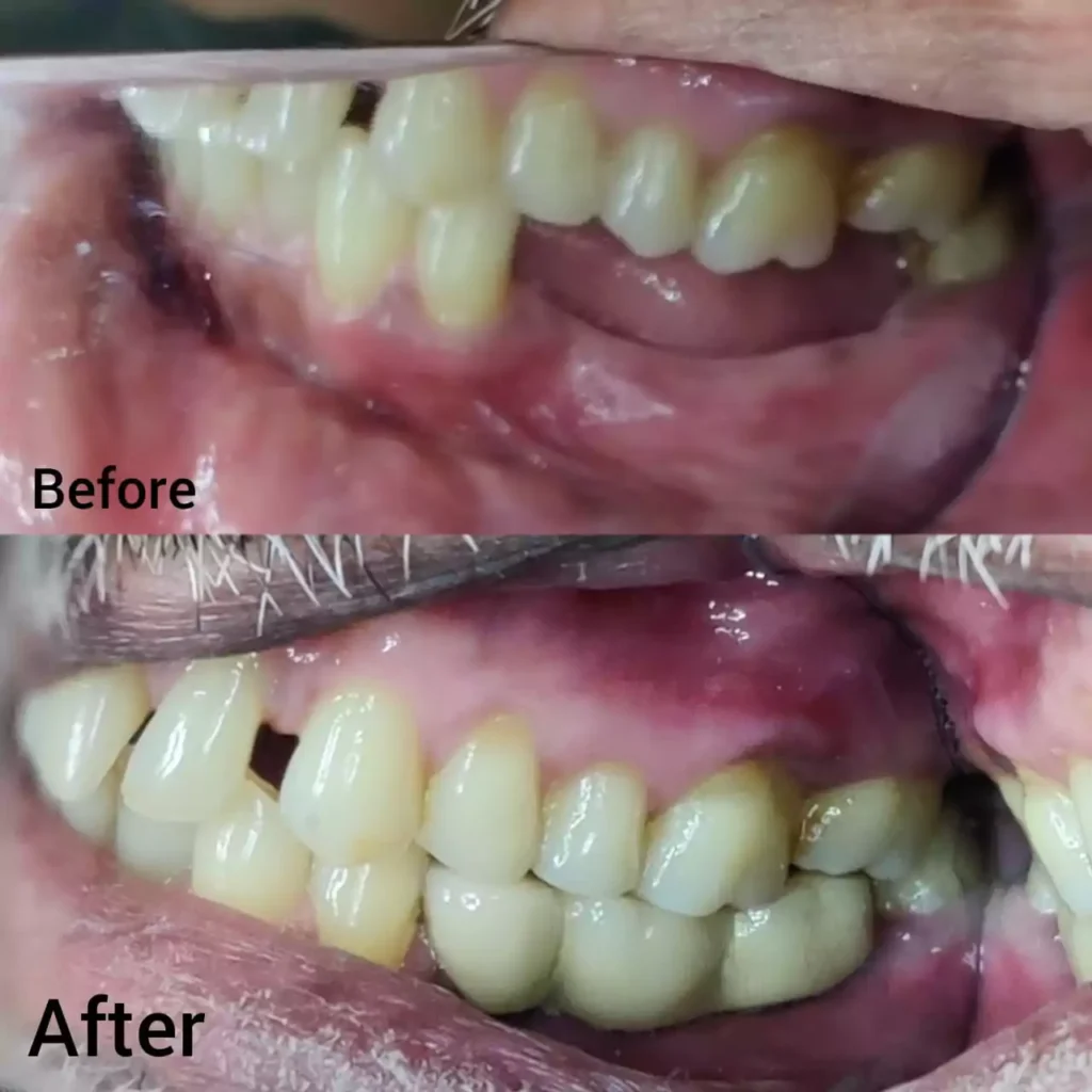 Replacement of Missing Teeth in Nigdi Pimpri Chinchwad Pune Face N Dental International Clinic before and after image
