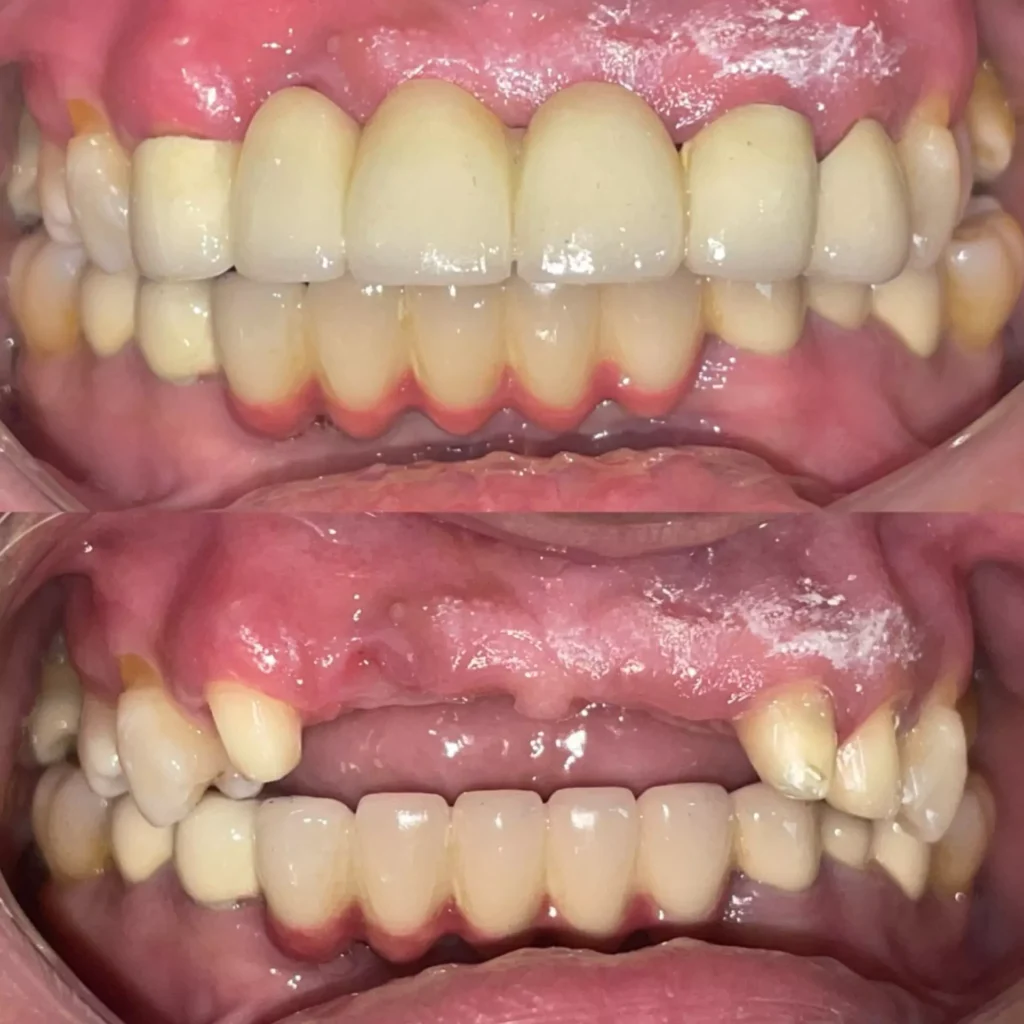 Fixed Dental Bridges in Nigdi Pimpri Chinchwad Pune Face N Dental International Clinic