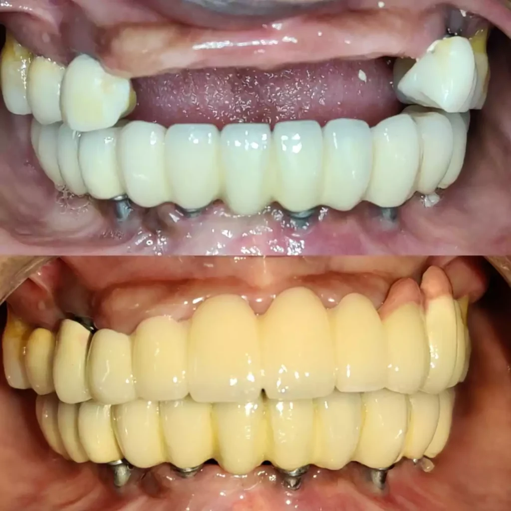 Face N Dental International Clinic Advance Dental Implant Surgery in Nigdi Primpri Chinchwad