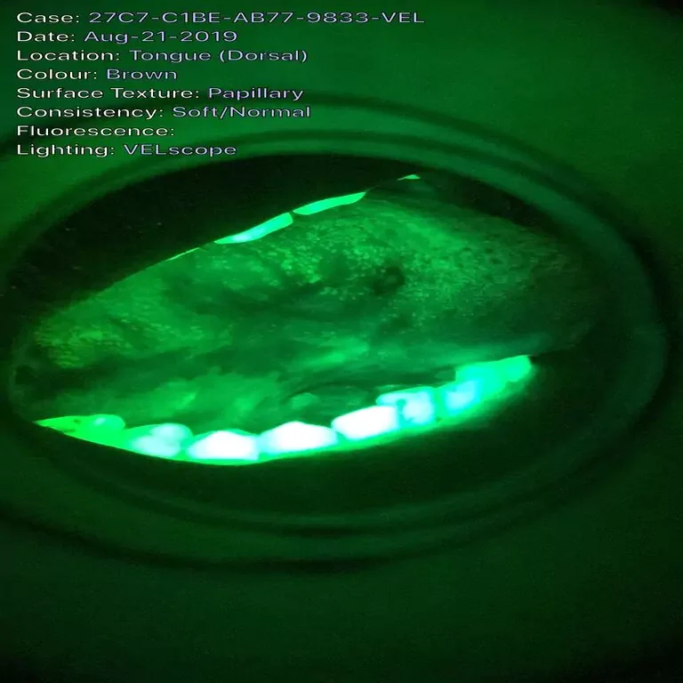 Face N Dental International Clinic in Nigdi Pimpri Chinchwad Velscan Machine – Pre-Cancer Detection7