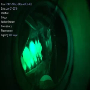 Face N Dental International Clinic in Nigdi Pimpri Chinchwad Velscan Machine – Pre-Cancer Detection6