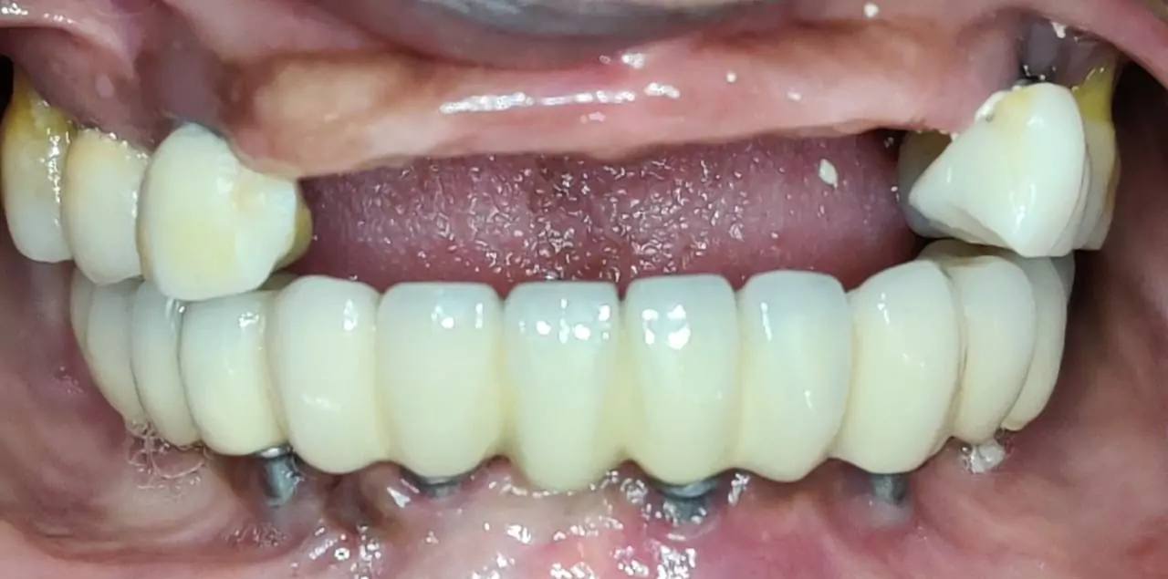 Face N Dental International Clinic Dental Implant before image In Nigdi Pune implant-1 Face N Dental International Clinic Dental Implant before image In Nigdi Pune