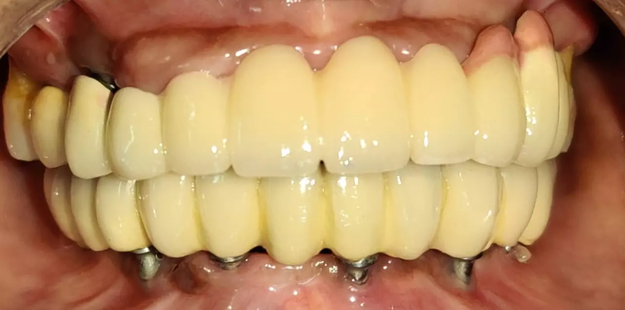 Face N Dental International Clinic Dental Implant after image In Nigdi Pune