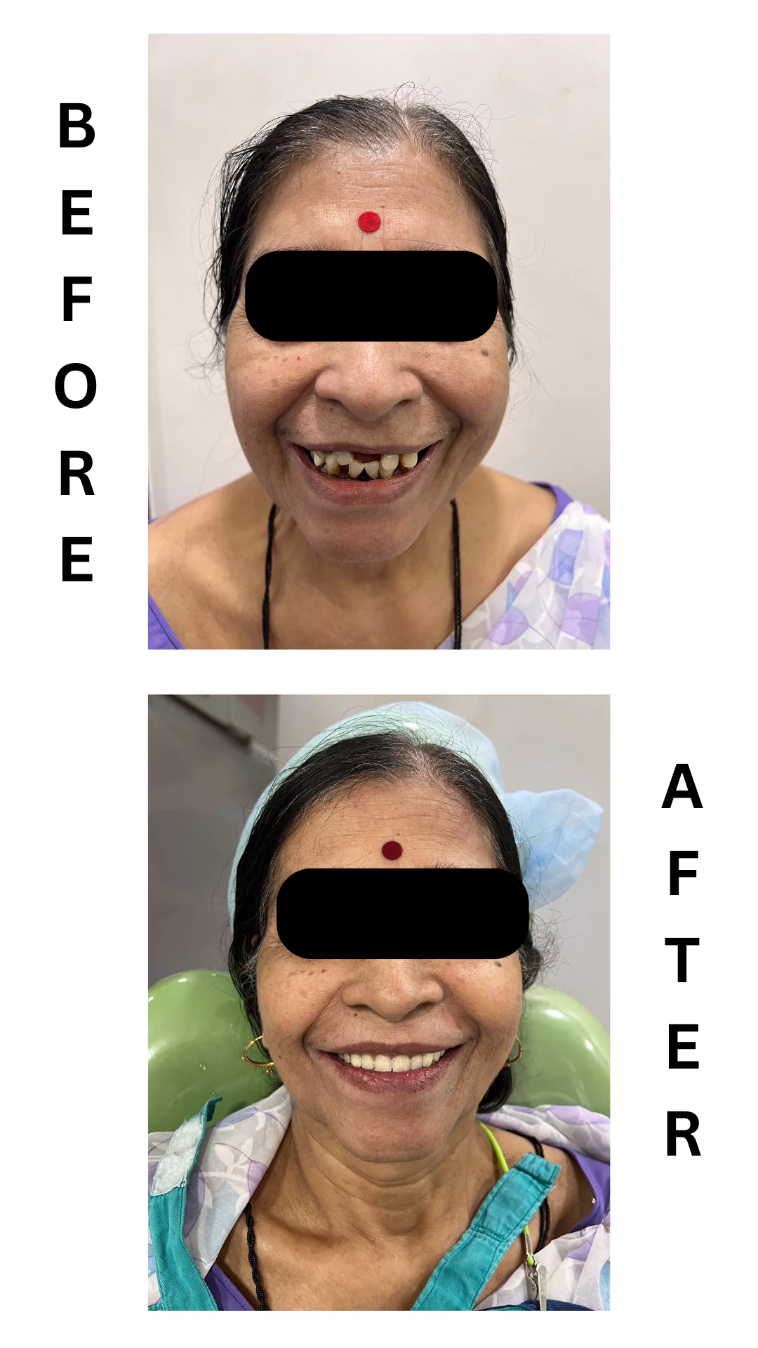Face N Dental International Clinic befor and after dental implants image3